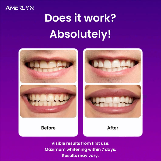 New Viral Whitening Strips