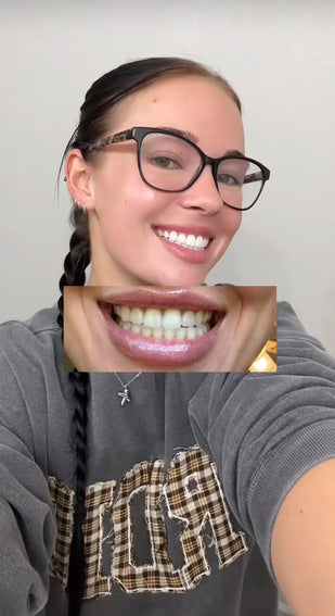 3. Say Hello to Whiter Teeth